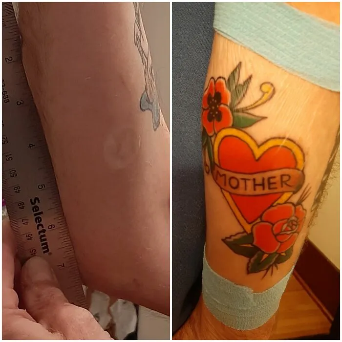 Before And After Of A 20yo "Drunken Shenanigans" Scar. My Mom Always Hated It!  The Scar Is Under The Little Poppy