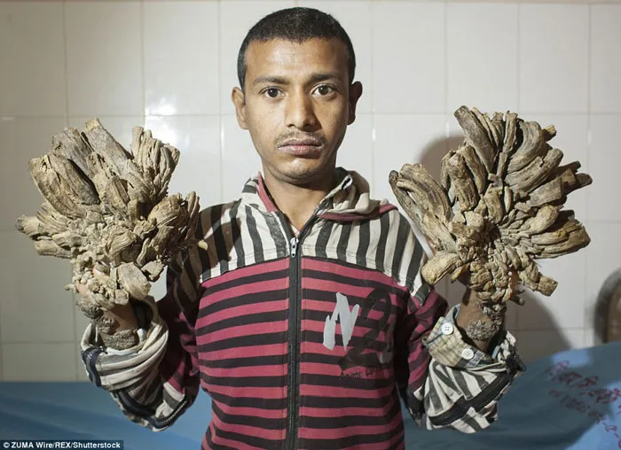 Epidermodysplasia verruciformis "Síndrome del hombre árbol"