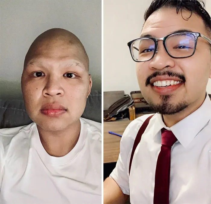 Hair Gains! After A Year Of Cancer, We're In Remission!