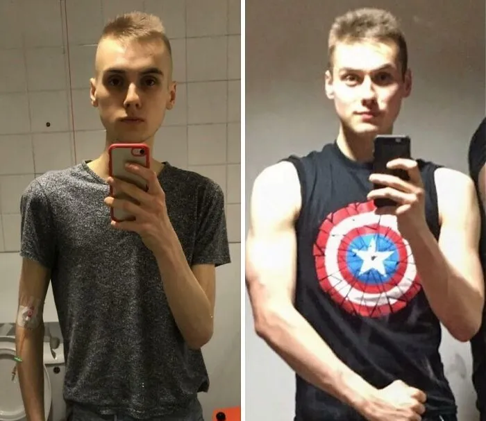 Anorexia, My Recovery