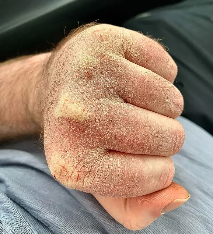 Consequences Of Working In A -10°C Lab Where I Have To Wash My Hands 40 Times A Day