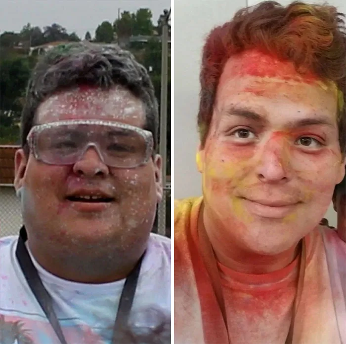 VSG Surgery Changed My Life