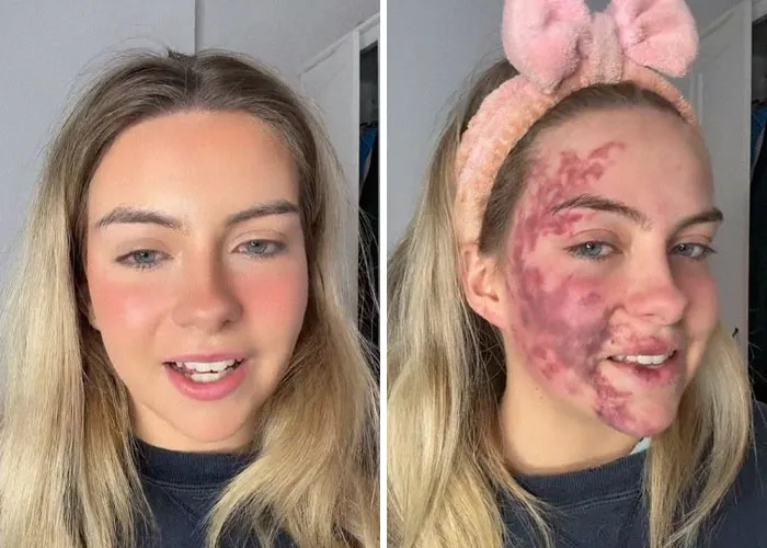 Woman's Face Starts Flaring Up Right Before Work, So She Films What It Looks Like To Raise Awareness
