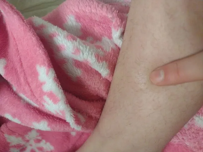 Not Showing Up Great Rn Because My Renard's Is Acting Up But I Dropped A Microwave Lasagna On My Leg And Got A Second Degree Burn 😋✌️