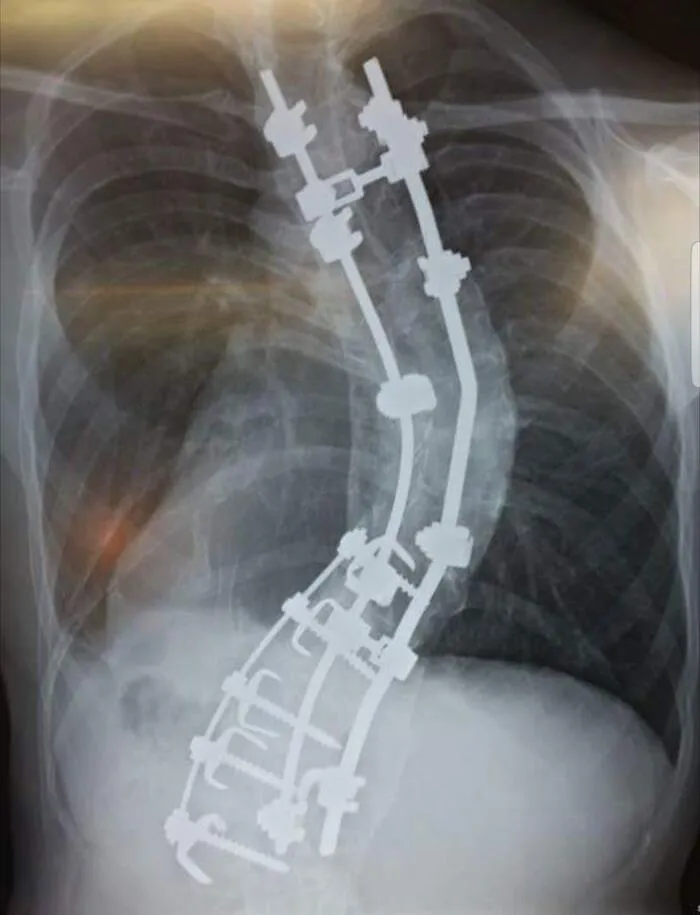 My Spine. I Went In For Surgery At 5'10", Came Out 6'2", I'm Supposed To Be 6'7"