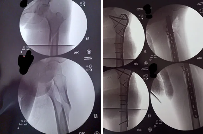 Merry Christmas, And A Broken Femur To Me