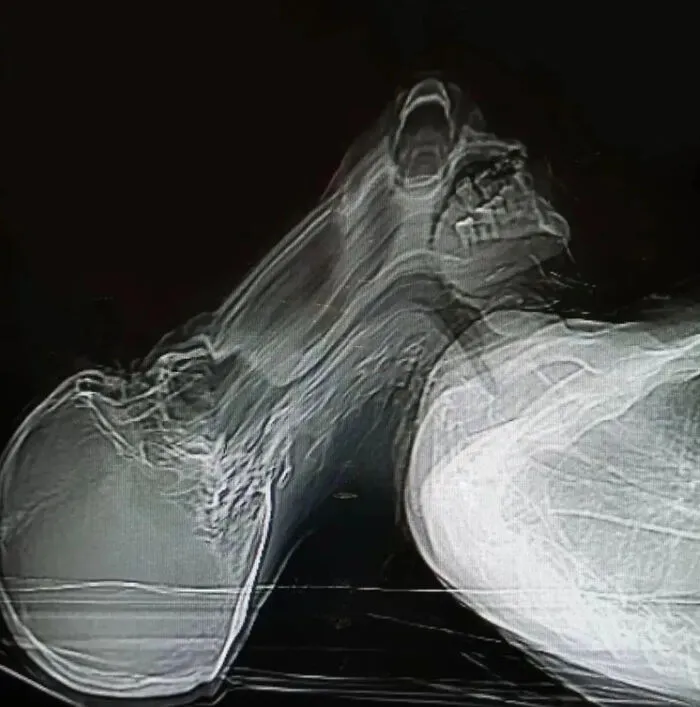 A Patient Experienced Claustrophobia And Had A Panic Attack During A Ct Scan