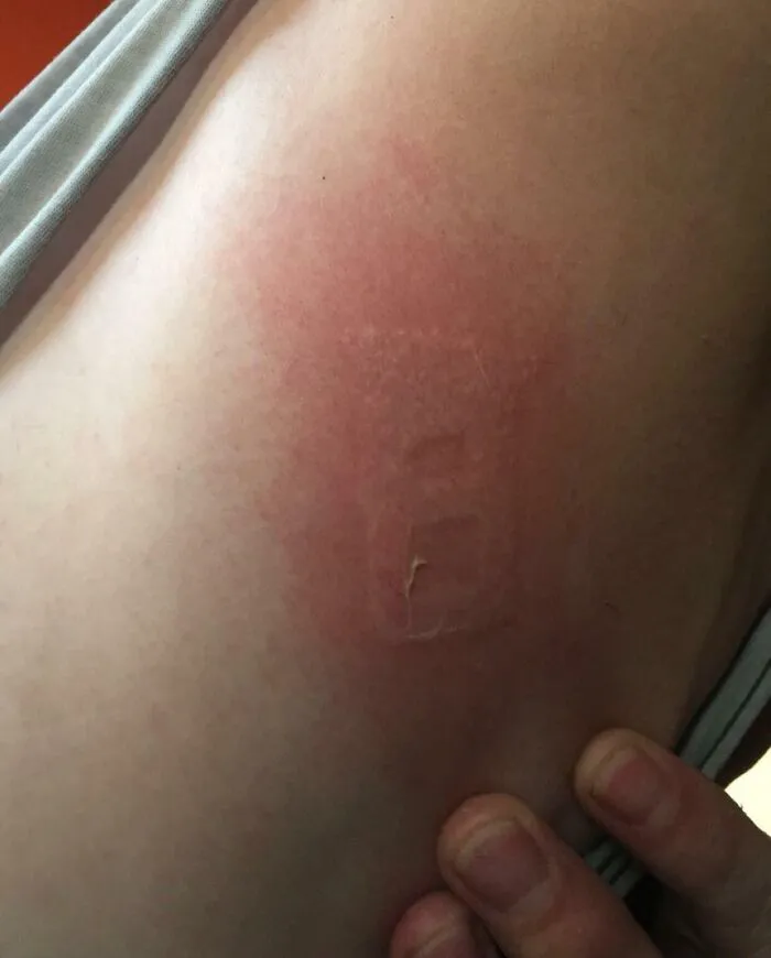 Llegó a 45 grados centígrados en nuestra área hoy y mi novio se quemó al instante con la hebilla de su cinturón de seguridad al entrar en su coche. Ya se está pelando