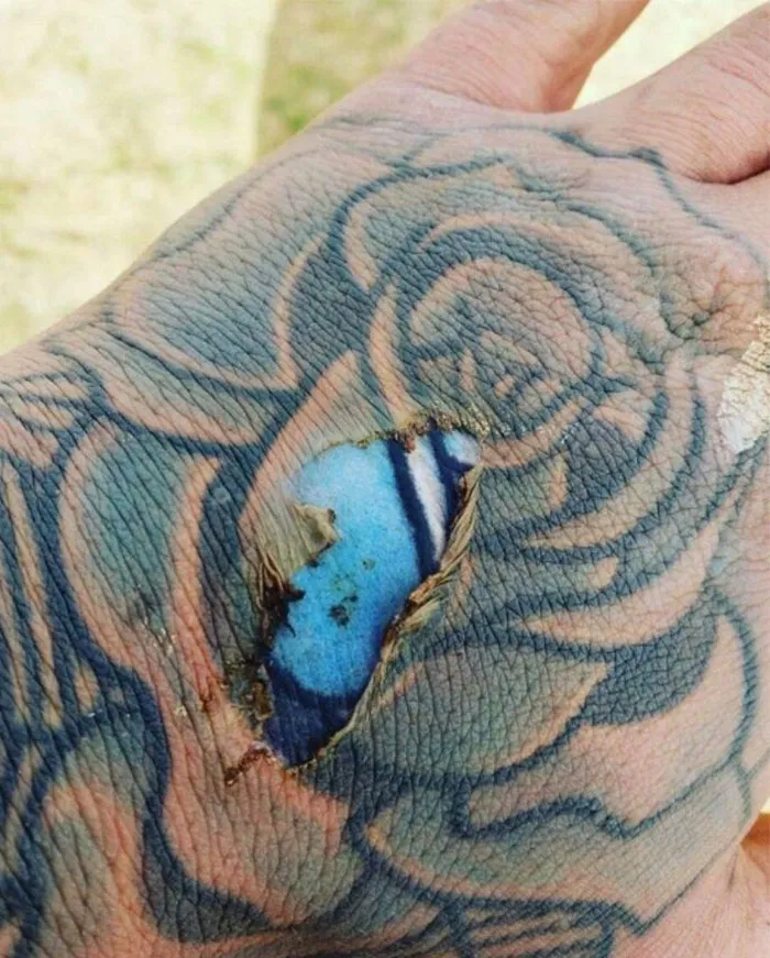 What Happens When You Get A Burn Over A Faded Tattoo