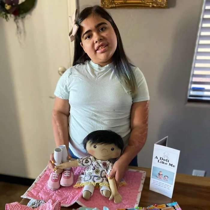 A girl with arm scars proudly presents her custom doll, which also has scars, offering kids a doll representing themselves.