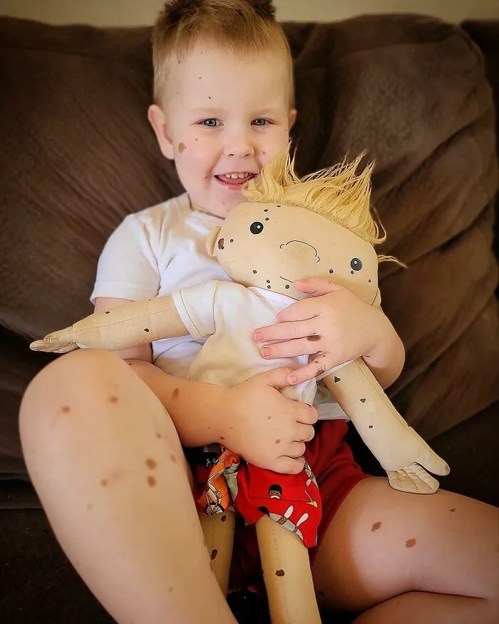 A young boy with birthmarks joyfully hugs his custom doll, which also features birthmarks, for kids' representation.