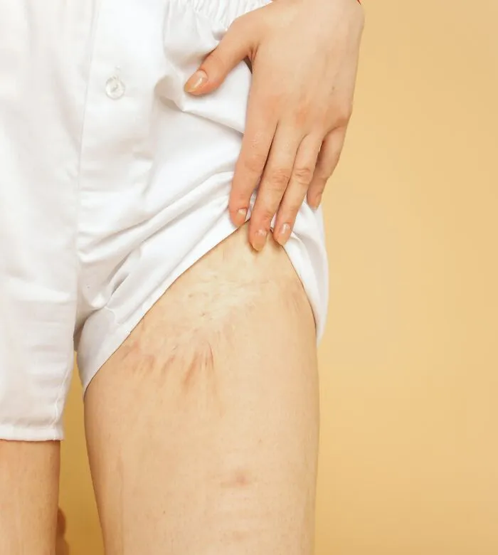 Woman Showing Her Scar On Leg 