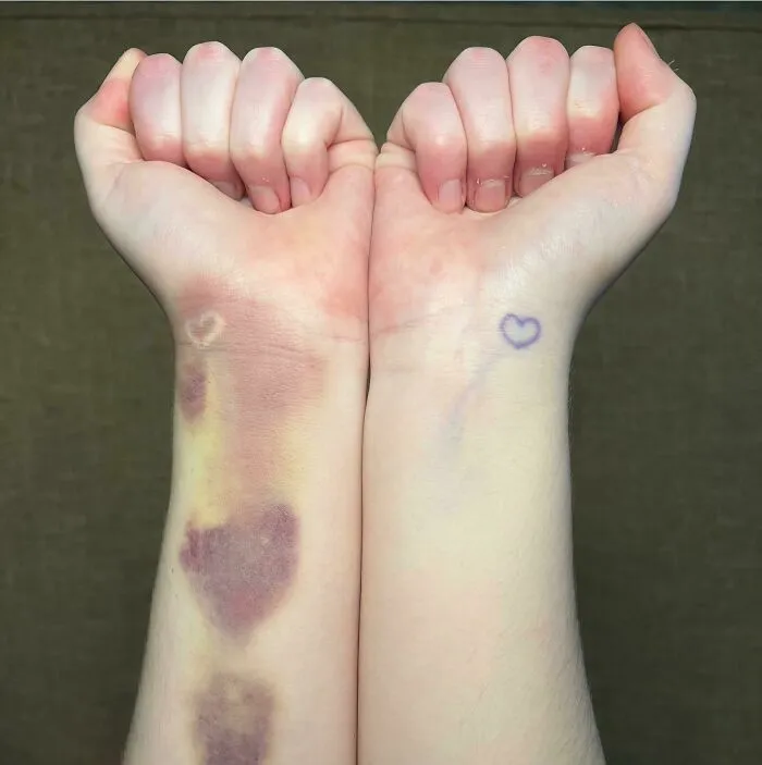 Two wrists with heart tattoos aligning with bruises, highlighting a perfect tattoo match.