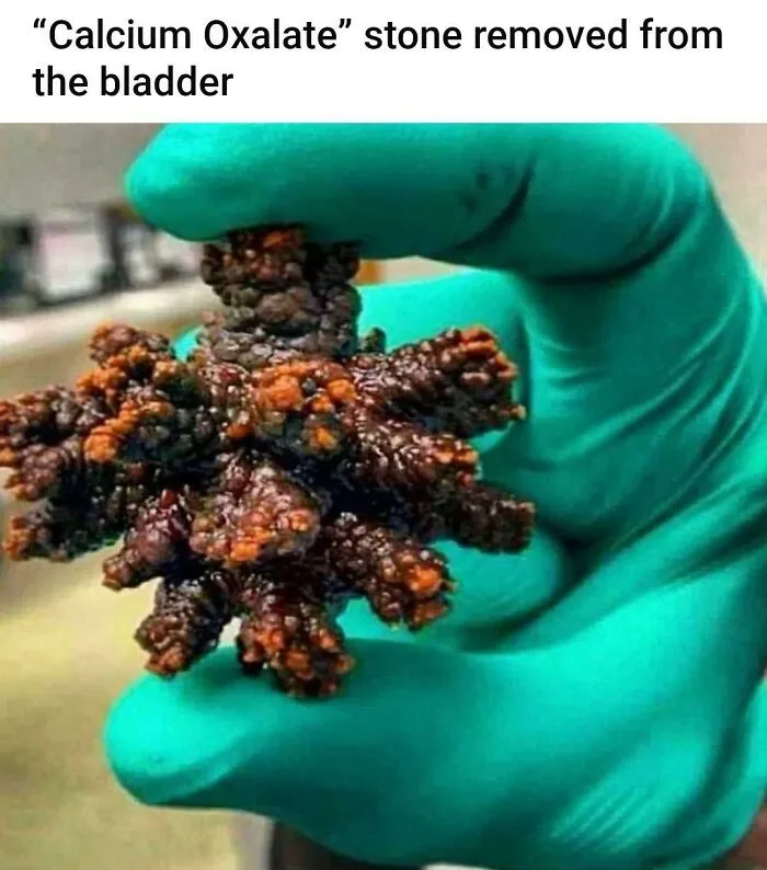 King Of The Kidney Stones