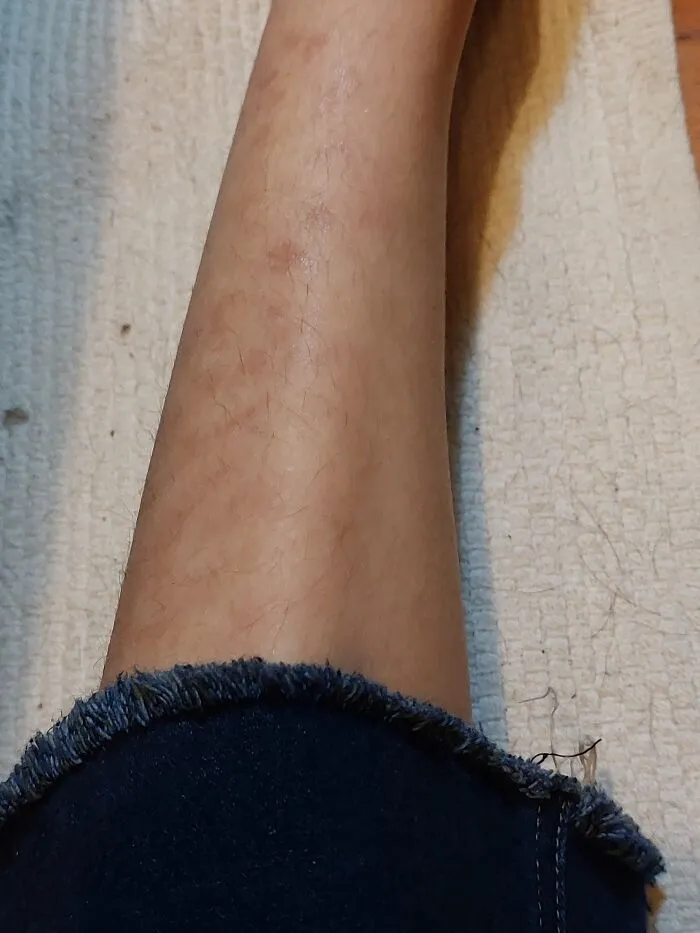 Not Exactly Cool But Interesting. It Gets Much Darker/Redder When It's Warmer Out, And No, It Is Not Scarring! I'll Explain In The Comments