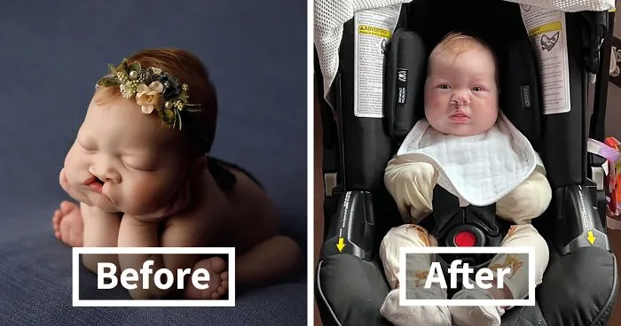 The Heart-Warming Story Of One Photograph: An Image Of A Baby With A Cleft Lip, Making Her Story Go Viral