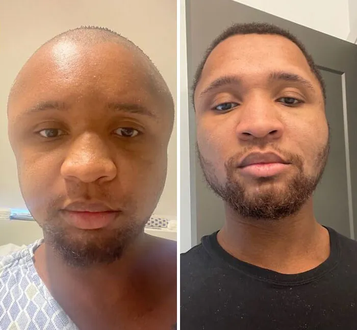 Tuve una reconstrucción facial hace 2 meses. Me decían Megamente, Ken Griffey Jr, Jimmy Neutron, etc. Ya pasaron 8 semanas y me siento mucho más seguro de mi aspecto 