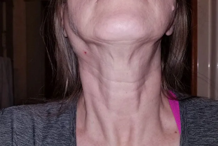 "Started Forgetting Words": 30 People Share Early Signs Of Cancer To Look Out For