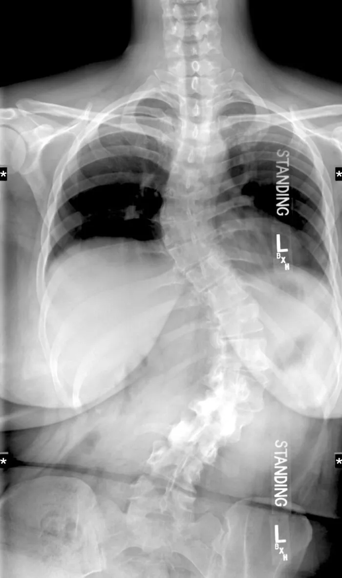 My (28f) Spine