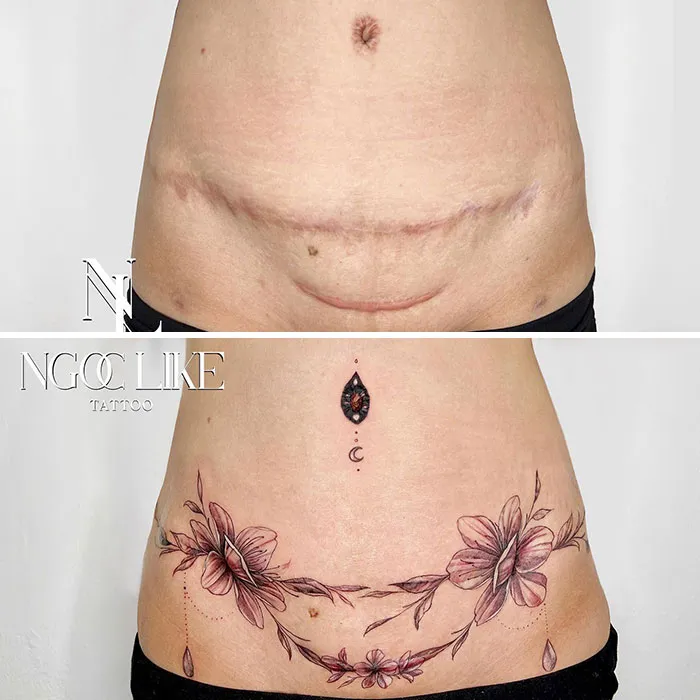 Scar covered with floral tattoo art. Top image shows scar; bottom image reveals floral design beautifully covering it.