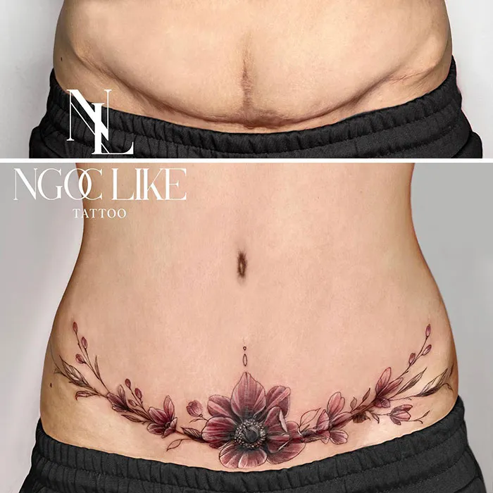 Tattoo artist beautifully covers a scar with floral tattoo design on lower abdomen.