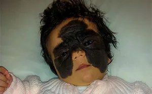 This 4-Year-Old Girl Has Undergone Multiple Surgeries To Get A Dangerous Birthmark Removed From Her Face