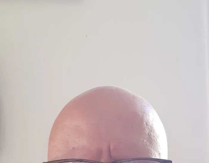 Hair? What Hair? All I Have Is This Di... Dome
