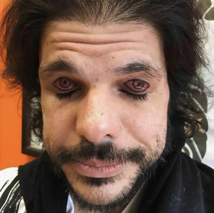 Man with tattooed eyelids featuring eyes, highlighting a permanent ink mistake.