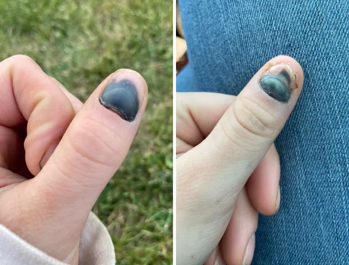 I Slammed My Finger In My Car Door, And Just As It Was About To Finish Healing, I Smashed It Again