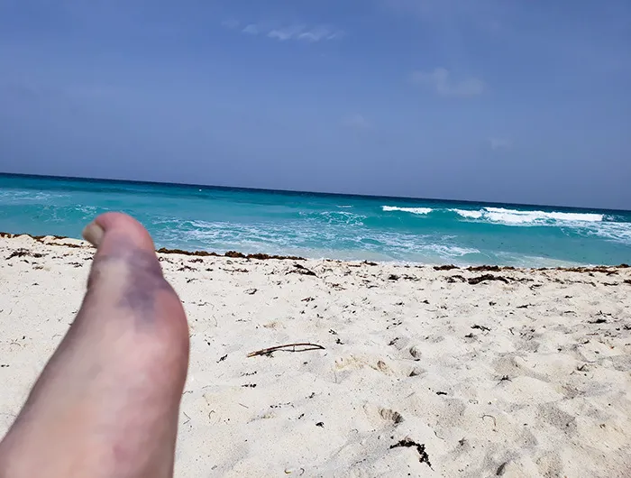 I Broke My Foot In Cancun On The First Day Of My Honeymoon