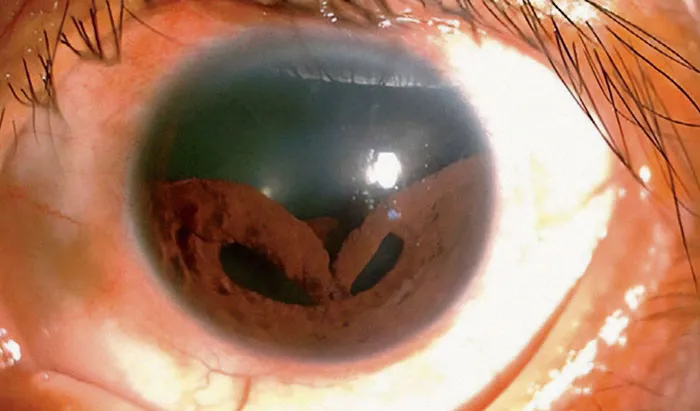 Colapso del iris tras ser golpeado con una cuerda de puenting