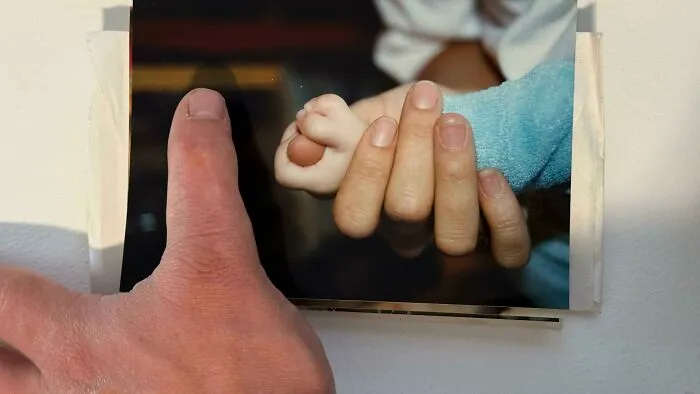 I Was Born With A Double Thumb But It Was Surgically Removed
