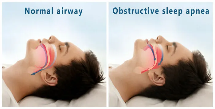 8. We Can Sleep Without Breathing. This Is Called Sleep Apnea. Sleep Apnea Is A Serious Medical Condition That Can Lead To Heart Problems And Other Health Problems