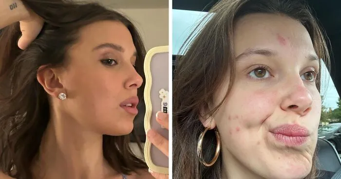Stranger Things' Millie Bobby Brown Embraces Acne Breakout, And The Internet Is All Here For It