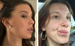 Stranger Things' Millie Bobby Brown Embraces Acne Breakout, And The Internet Is All Here For It