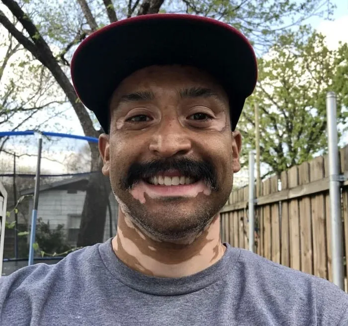 Embrace What You Got. At 40 Years Of Age I Was Diagnosed With Vitiligo. Never Be Ashamed Or Embarrassed (I Know Easier Said Than Done) 