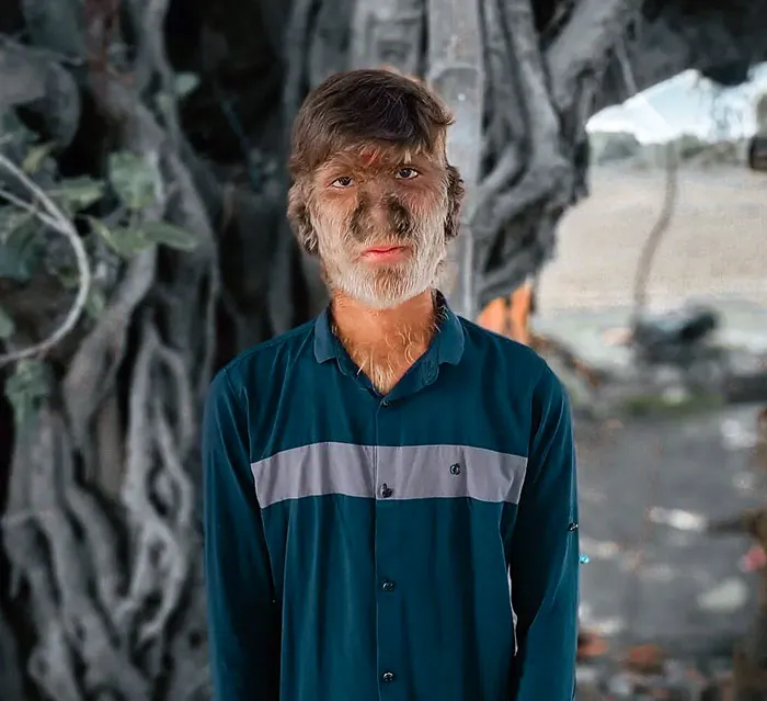 A Teenager From India Has A Rare Condition Called "Werewolf Syndrome",  Or Also Known As Hypertrichosis