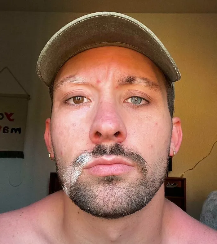 I Have Vitiligo And Heterochromia
