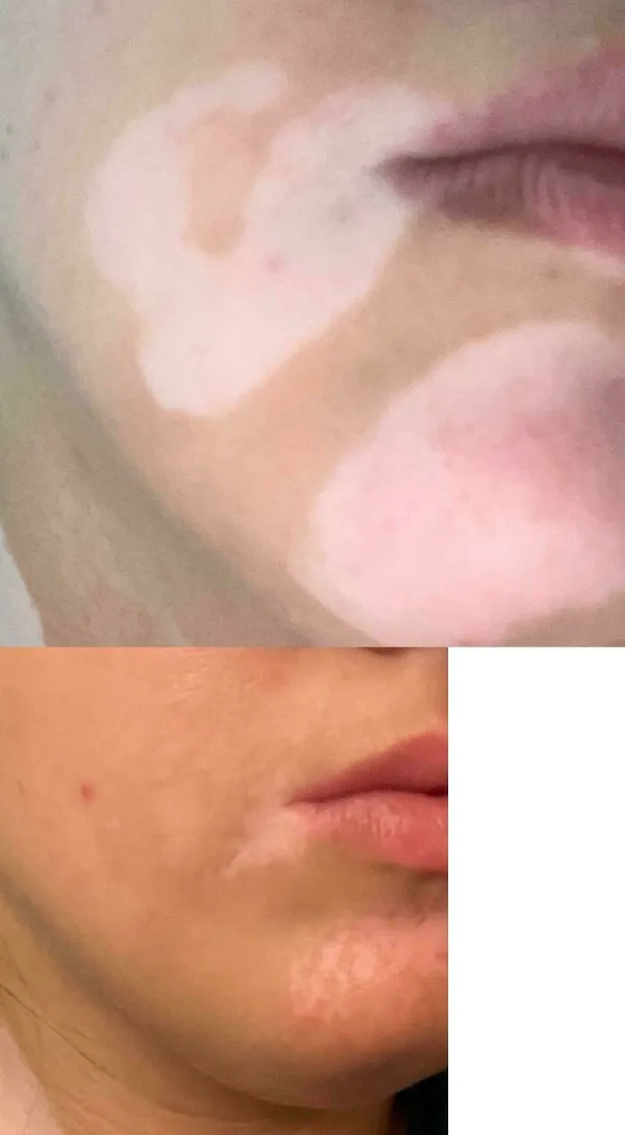 Two Month Repigmentation During A Vitiligo Clinical Trial