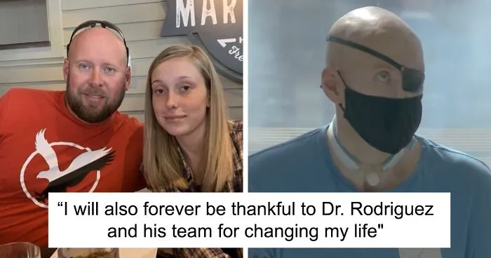 “I Don’t Want To Wear A Mask”: Veteran Who Lost Half Of His Face Receives Eyeball Transplant