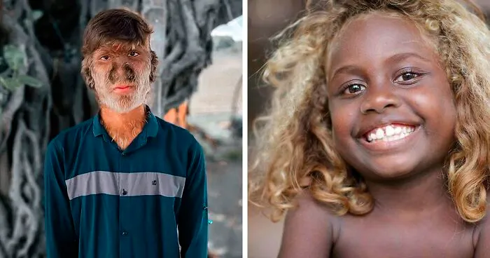 50 Times Human Genetics Led To Some Unique Body Characteristics