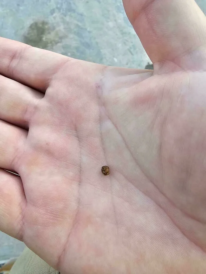 En mi primer día de trabajo, justo antes de la reunión para conocer a todo el mundo, he pasado una piedra del riñón de 4 mms
