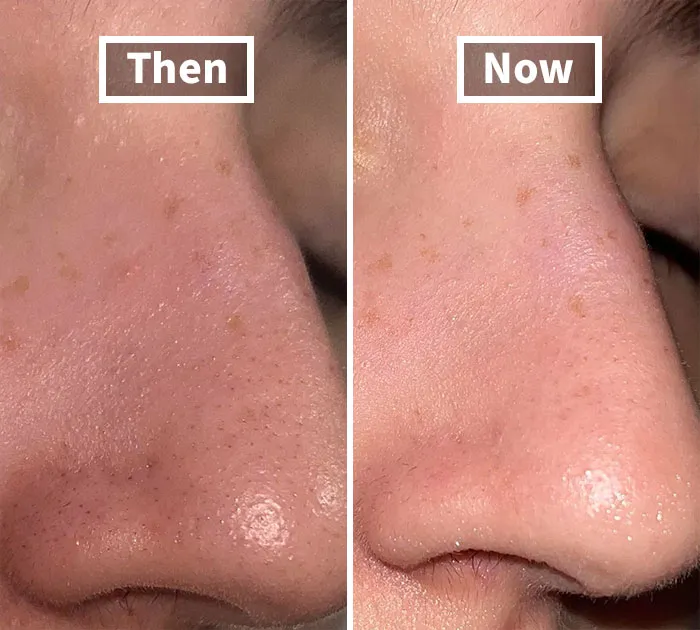 Giving You That 'Just Woke Up Like This' Look After A Night Out, <span Style="Font:inherit;color:#d74b1f;"> Anua Heartleaf Pore Control Cleansing Oil</Span> Is Your Selfie's Unsung Hero When Makeup And Blackheads Go Bye-Bye