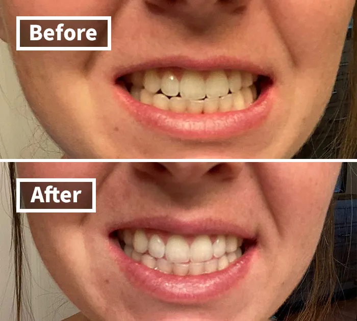 Coffee, Red Wine, And Life Can’t Dull Your Sparkle—not When You've Got The Venus Visage Teeth Whitening Pen In Your Arsenal
