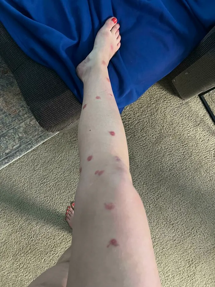 Al parecer soy alérgica a los mosquitos, por si no eran ya lo bastante molestos