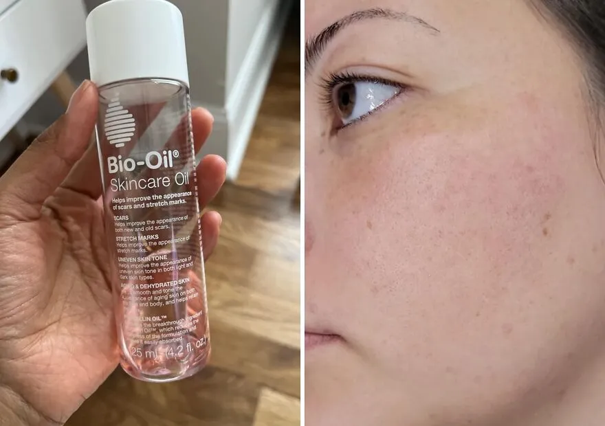 No Marks Left Behind: <span Style="Font:inherit;color:#d74b1f;"> Bio-Oil Skincare </Span>- Your Go-To For Flawless Skin!