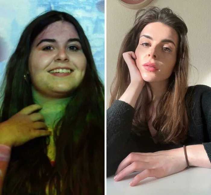 From 94 Kg To 53 Kg. 41 Kg Lost. Got Dumped Because Of My Weight, Lost Weight, Got Dumped Because Of Loose Skin. Two Times. Decided To Forget About Men And Focus On Myself Now