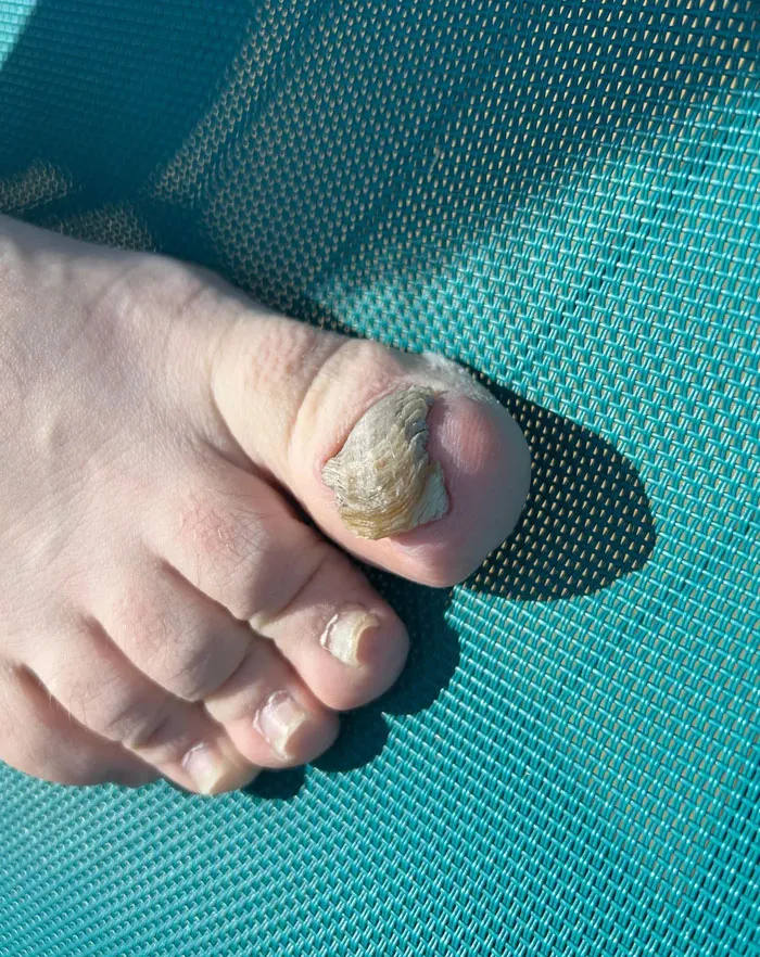 Mi hermano se niega a hacer nada con su uña