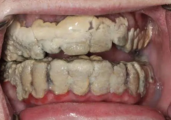 20 años sin lavarse los dientes