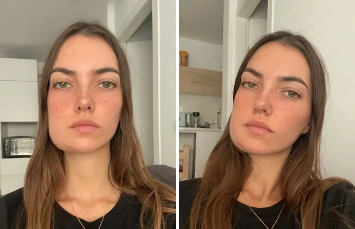 Inflamación tras sacarme un diente
